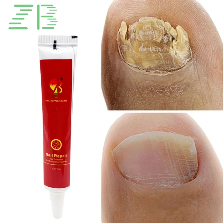 Nail Fungus Removal Cream